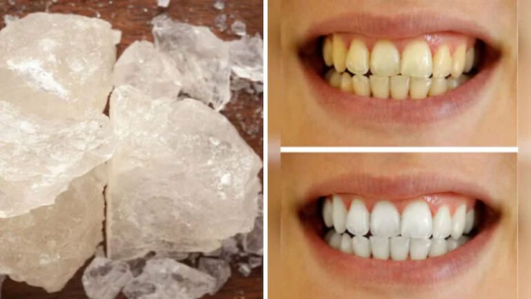 Alum For Teeth Whitening